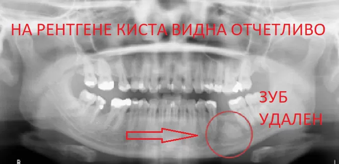 Кистогранулема привела к удалению зуба